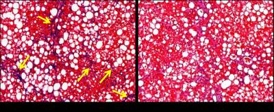 Silencing TAZ Reverses Liver Fibrosis