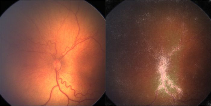 Retina with retinopathy with AI output