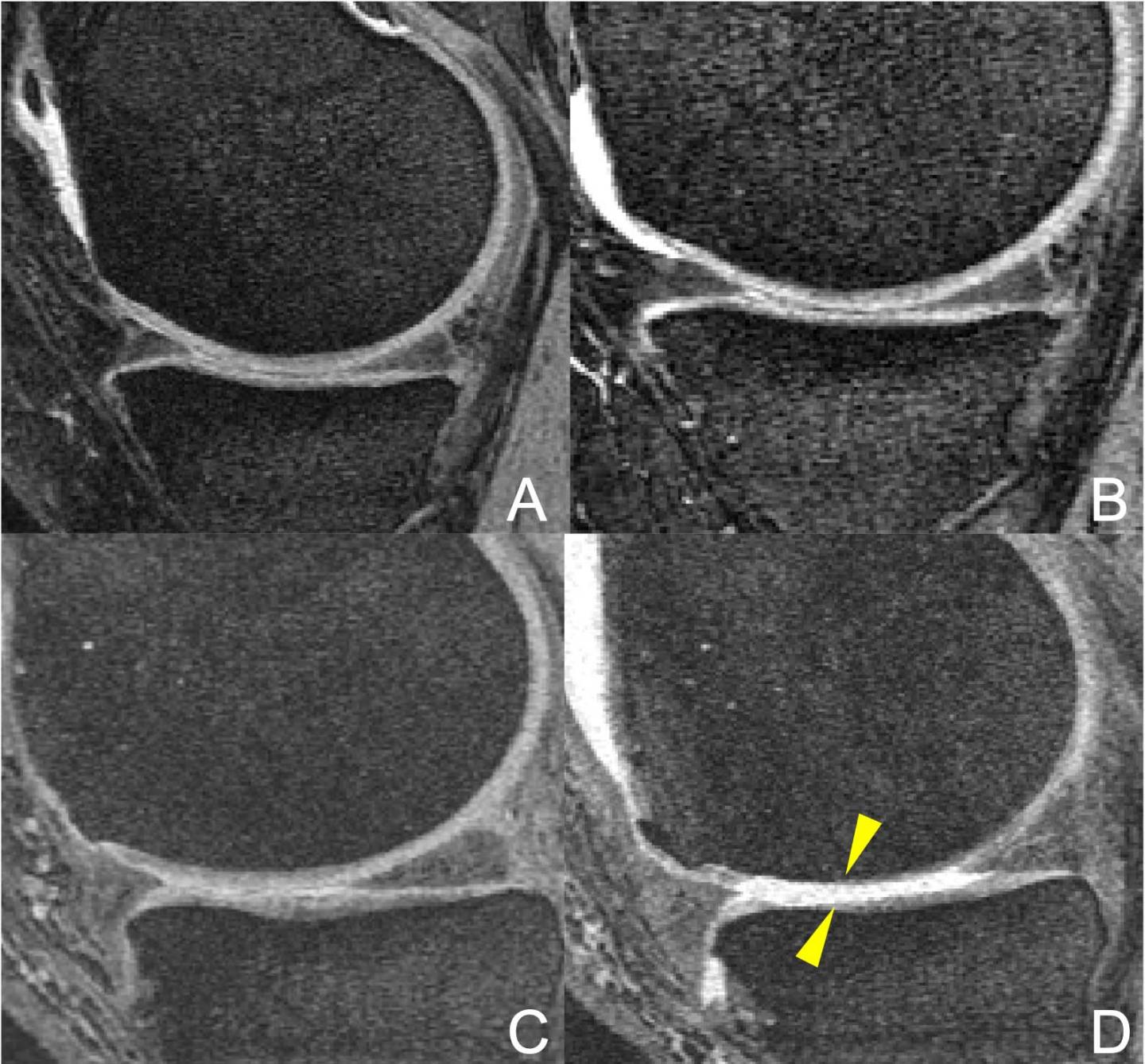 Racket Sports May Worsen Knee Arthritis