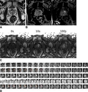 Images in a 64-year-old male patient who underwent MRI for clinical suspicion of prostate cancer