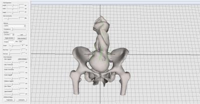 First Patient-Specific 3-D Virtual Birth Simulator