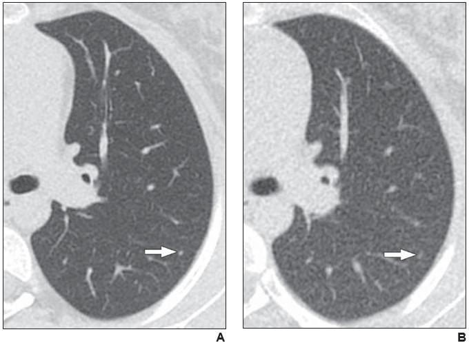 17-Year-Old Girl With Osteosarcoma