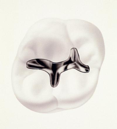 Dental Fillings