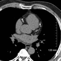 CT Shows Enlarged Aortas in Former Pro Football Players (3 of 3)