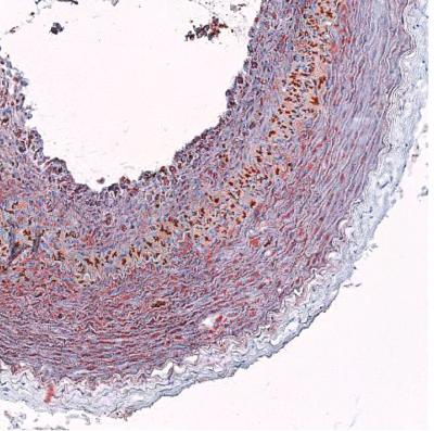 Fatty Arteries to 'Go Green' With New Screening Technique (4 of 9)