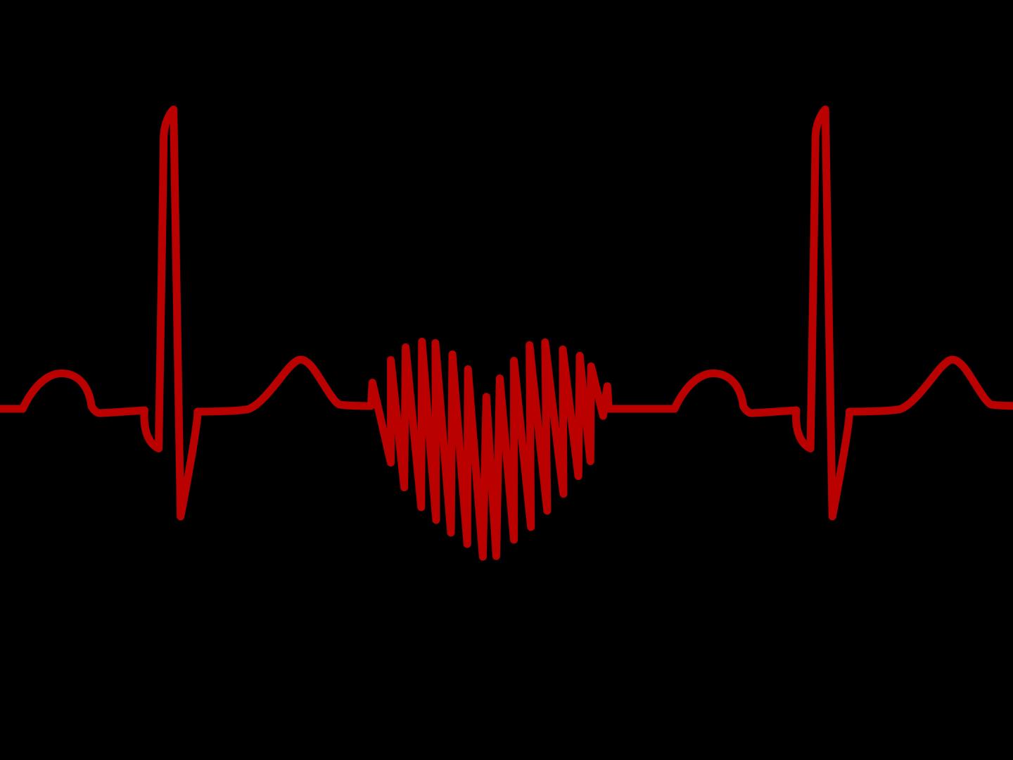 Sudden Cardiac Arrest -- Heart Rhythm -- Chugh