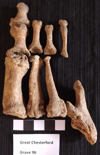Leprosy Remains from Great Chesterford