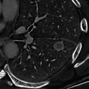 62-year-old man with history of oropharyngeal cancer, treated by chemoradiation therapy