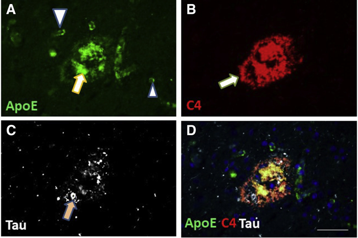 Immunofluorescence microscopy showing a single neuritic amyloid plaque with the localization of Apolipoprotein E (ApoE)