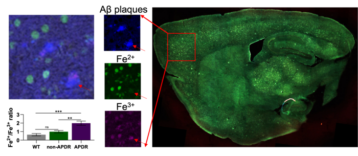 Fe3+/Fe2+ ratio increases in brain regions containing amyloid plaques