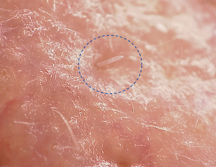 Close-up of skin with mites