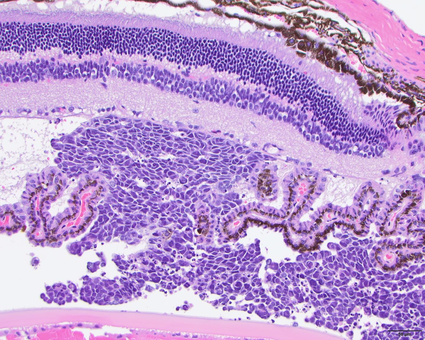 Retinoblastoma Xenograft