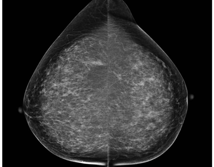Screening Mammogram [IMAGE] EurekAlert! Science News Releases