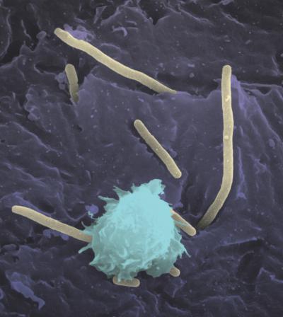 Urinary Tract Infection