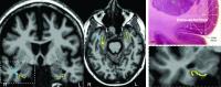 Automated Imaging Reveals Where TAU Protein Originates in the Brain in Alzheimer's Disease (2 of 3)