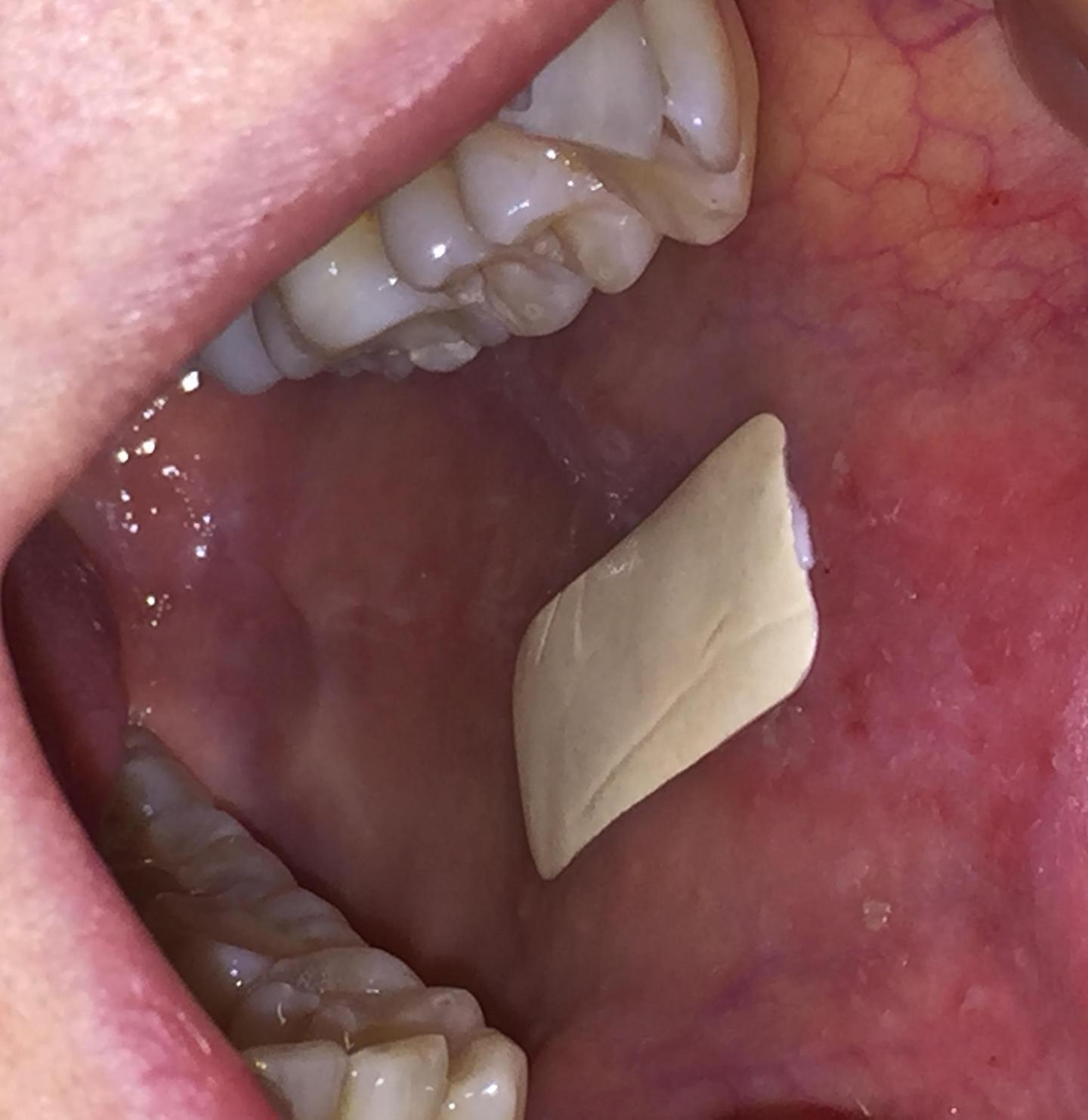 Plaster for Inside the Mouth