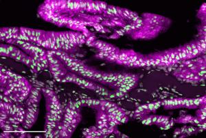 Cholesterol-Lowering Therapy May Hinder Aggressive Type of Colorectal Tumor