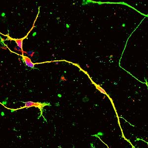 AAV gene therapy-based genome editing recovered myelination in human CMT1A patient nerve differentiated from iPS cells