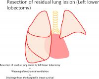 Resection of Lung Lesion