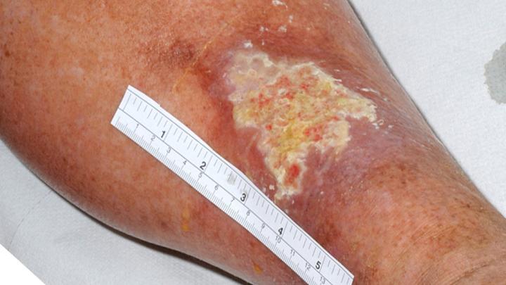 Greater Concentration on Wound Care Would Save Nhs Millions Argues Prof of Vascular Surgery