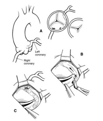 AATS Consensus Statement Helps Manage Treatment of Coronary Anomalies