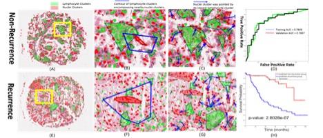 Tissue slide: Spatial Architecture of Immune Cells as Predictive for Treatment of Lung Cancer