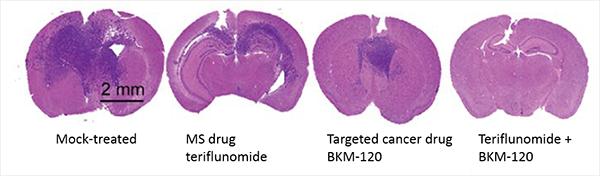 MS Drug on Glioblastoma Graphic; UcC San Diego School of Medicine