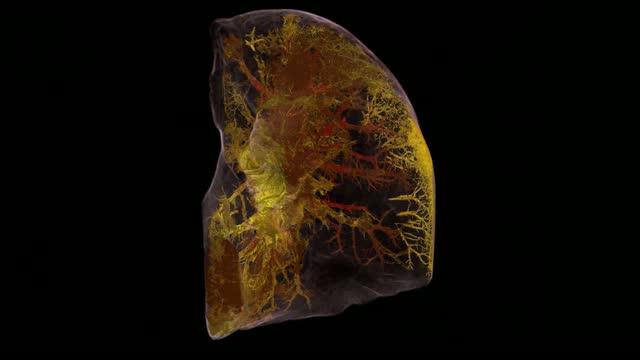 Seeing inside a COVID-19 injured lung