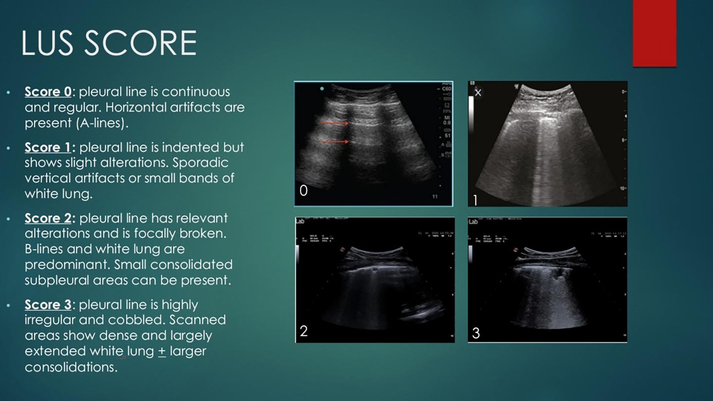 Lung ultrasounds could help determine covid-1 | eurekalert!