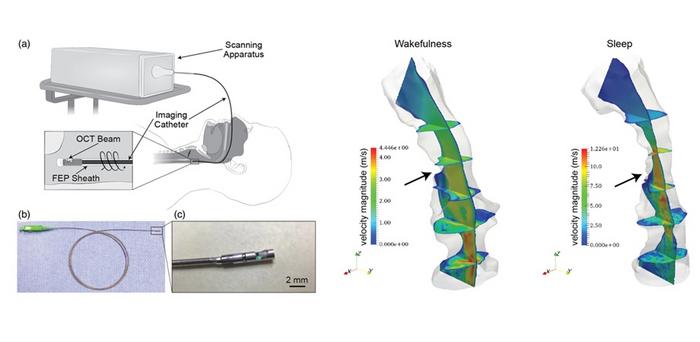 High-fidelity structural information and airflow data of a sleeping patient’s upper airway were obtained through OCT imaging and 3D reconstruction, allowing for precise identification of various anatomical sites with airflow obstruction.