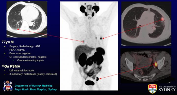 Ga-68 PSMA PET/CT Detection of Metastases