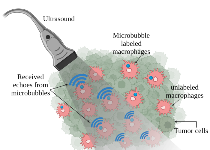 Attaching microbubbles to macrophages can create high-resolution and sensitive tracking images