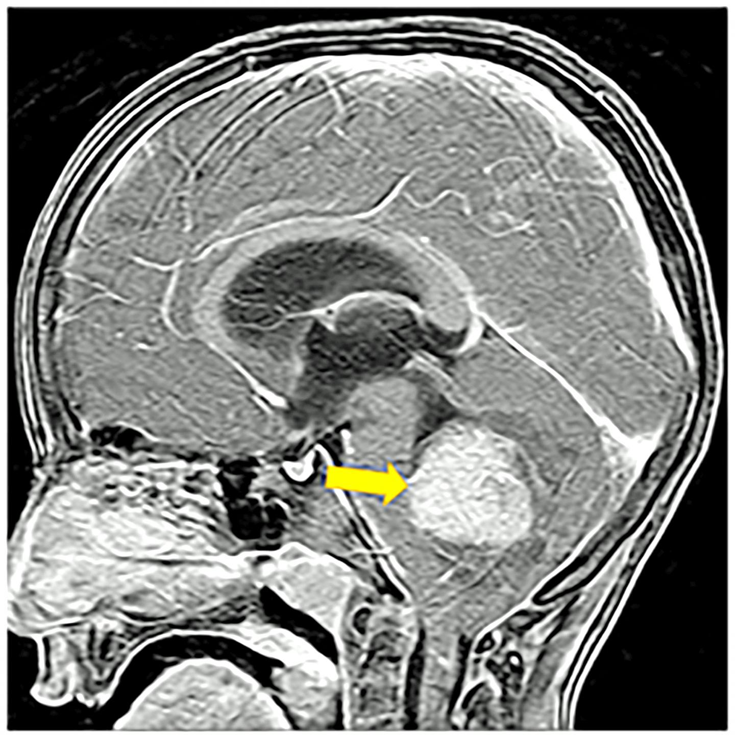 brain mri scan tumor
