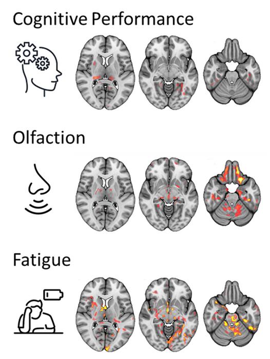 MRI Brain Changes in Long-COVID