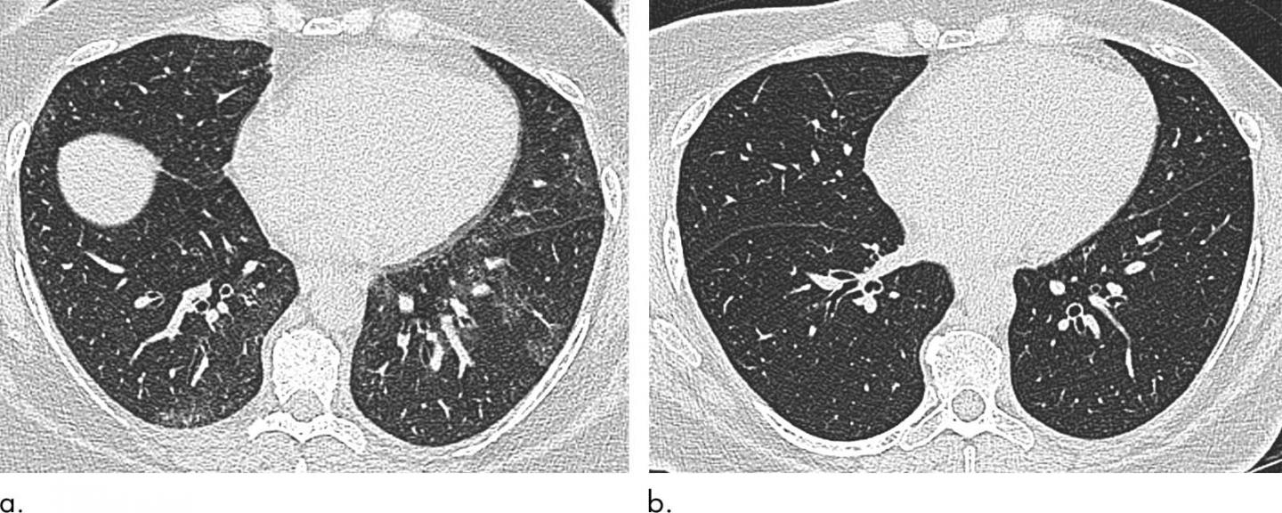 Weight Loss Surgery Improves Breathing Issues in Obese Patients