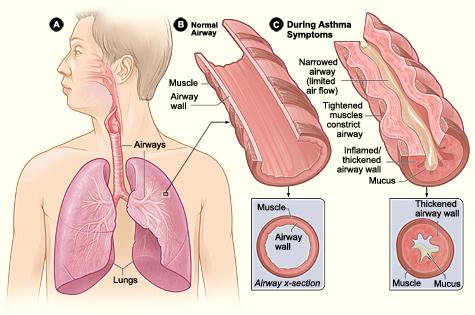 Asthma in the Lungs