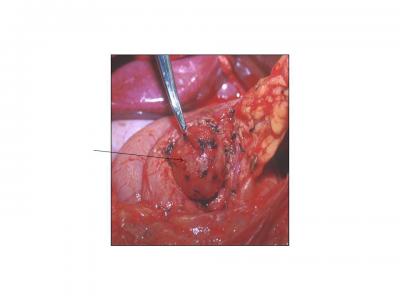 Benign Pancreatic Cyst