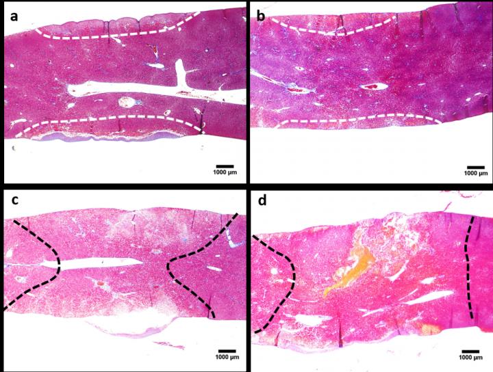 The Increase in the Extent of Tissue Ablation Achieved by Combining Reversible Electroporation Pulse