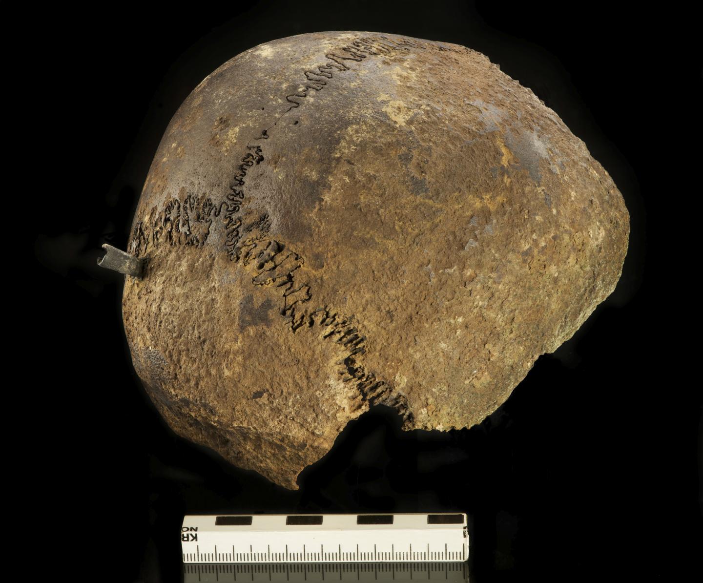 Skull with Small Metal Object Embedded in It