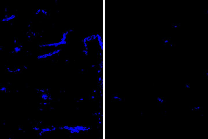 Anti-APOE antibody removes amyloid plaques