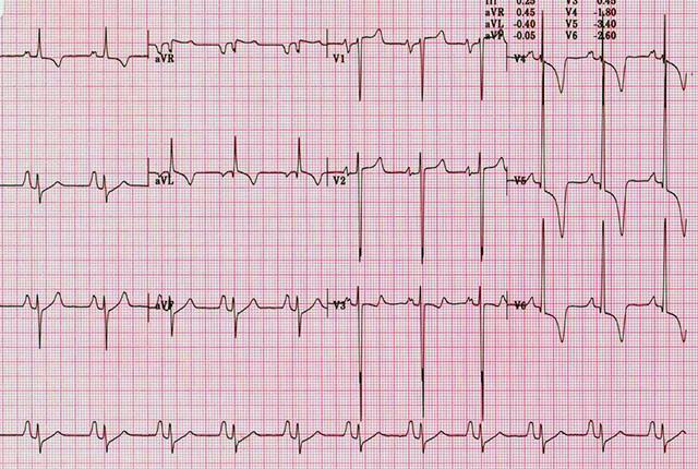 Electrocardiogram - Abnormal