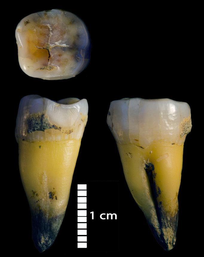 Second lower molar