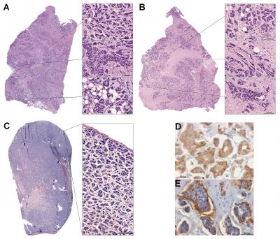 Two Regions of Invasive Micropapillary Carcinoma