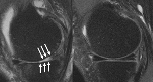 Steroid Injections Worsen Knee Arthritis