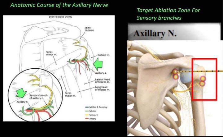 Novel Technique 'Stuns' Arthritis Pain in Shoulder and Hip
