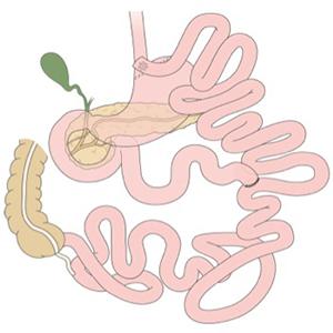 Gastric Bypass Illustration
