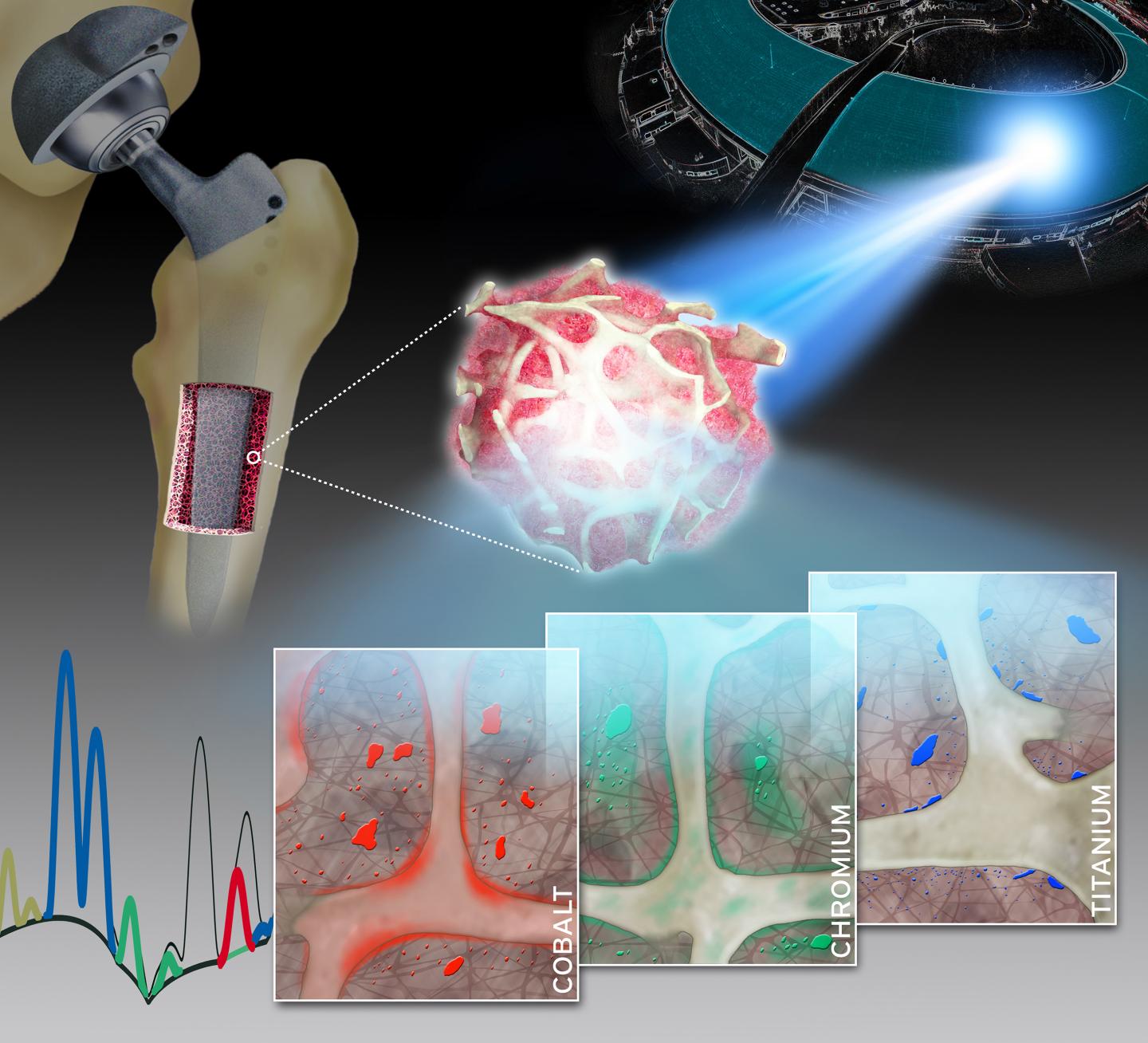 Synchrotron X-Ray Fluorescence Images of Human Bone and Bone Marrow Biopsies