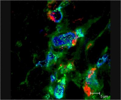 Interferon Beta in Leprosy