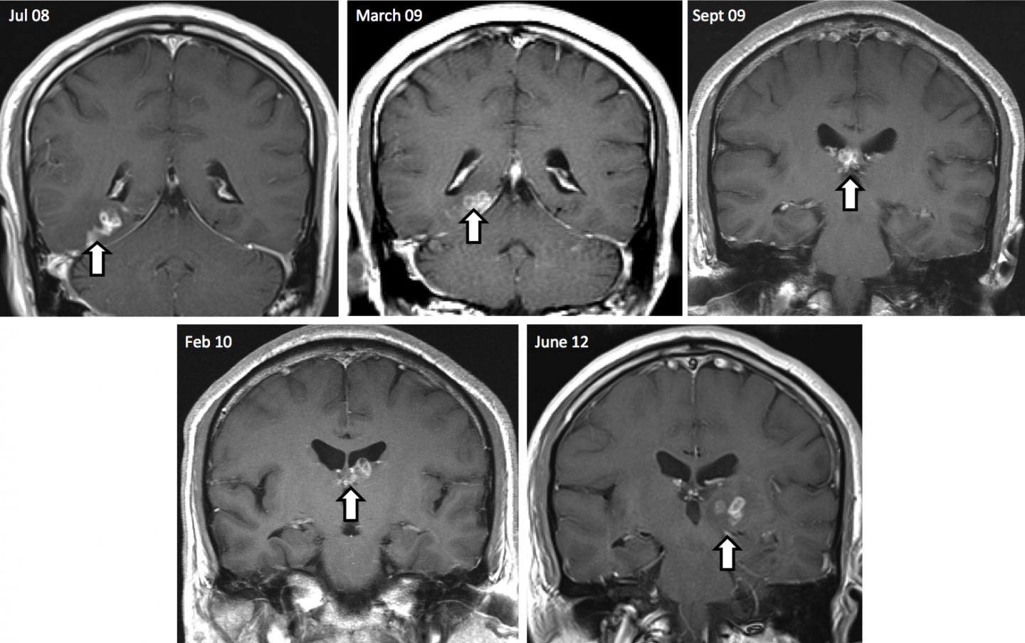 Brain MRI Scan Over Time