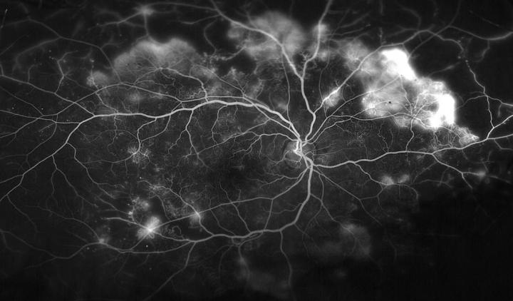 Blood Vessels in the Retina